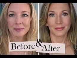If you are looking into getting advice about botox / brow lifts for hooded eyes, i had a good. How I Fixed My Droopy Hooded Eyelids Youtube
