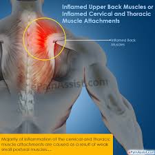 But to understand what causes a strained back, let's focus on three components: Inflamed Upper Back Muscles Treatment Causes Symptoms