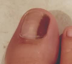 The underside of your toenails smell bad because you a: A Stepwise Approach To Evaluating And Managing Longitudinal Melanonychia Podiatry Today
