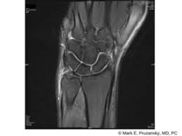 It also maintains stability of the radius and ulna during grasping and rotating activities of the hands. Triangular Fibrocartilage Complex Tears New York Ny Handsport Surgery Institute