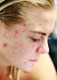 Hair loss can affect any part of the body, including the scalp. Prescription Acne Medication Aids Hair Loss Treatment Response
