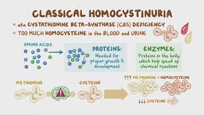 Image result for Homocystinuria