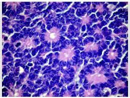 Retinoblastoma is an embryonal tumour and is the most common malignant tumour of the eye. Retinoblastoma Pathology Ento Key
