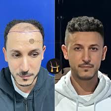 زراعة الشعر في تركيا‎ (@holdinhairclinic) · Instagram photos and videos