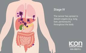What are the common signs of lung cancer? Colorectal Cancer Icon Cancer Centre Hong Kong