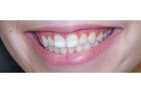 Repair White Spots White Marks On Teeth With Remineralising Toothpaste