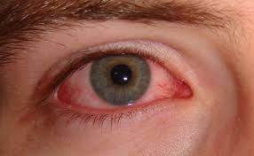 Konjunktivitis Wikipedia