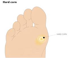 Image result for Corns