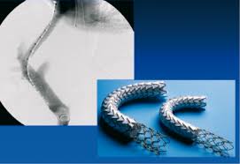 Place Du Tips Dans L Hemorragie Digestive Par Hypertension Portale Htp Et L Ascite Refractaire Fmc Hge