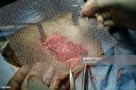 Surgeon Holding Polypropylene Mesh For Hernia Repair Hernia Repair Abdominal Surgery Abdominal Hernia