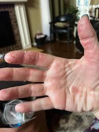Image result for Hand Infection