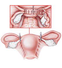 Hysterectomies Removal Of The Uterus Complications Alternatives