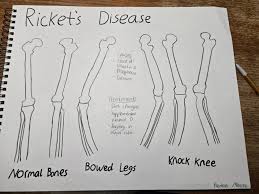 Image result for Rickets