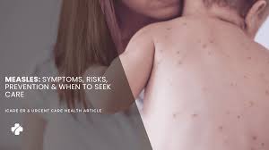 Image result for measles