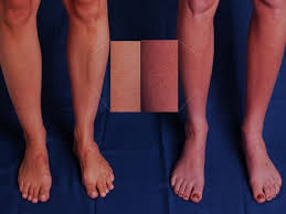 Difference Between Normal Non Pots Legs And Pots Legs Yup Mine Look Exactly Like The Ones On The Right Dysautonomia Pots Syndrome Chronic Fatigue Syndrome