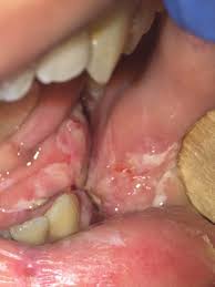 Rhizopus species are the most common causative organisms. Successful Mandibular Mucormycosis Treatment In The Severely Neutropenic Patient Journal Of Oral And Maxillofacial Surgery