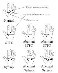 People most often have 3 creases in their palms. Examples Of Palmar Crease Variants Method 1 Based On The Download Scientific Diagram
