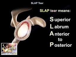 Image result for SLAP Lesion