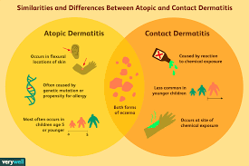 Image result for Atopic eczema atopic dermatitis