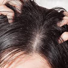 Thanks to the way it grows, and the demands of caring for it, people with curly hair experience specific challenges that those with straight hair don't. Some Effective Ways To Deal With Dandruff Best Anti Dandruff Shampoo