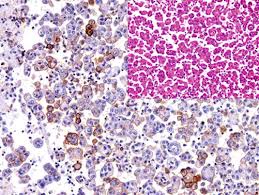 We have therefore evaluated a newly described tumor . Markers And Immunoprofile Of Mesothelioma Tumors Of The Peritoneum Oncohema Key