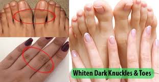 Ingrown toenails (onychocryptosis) result when the toenail grows into the nail fold. This Is How You Can Get Rid Of Dark Knuckles And Toes Easily At Home Dark Knuckles Lighten Dark Spots Skin So Soft