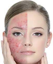 Red spots and acne scars: How To Get Rid Of Acne Marks Fast Redness On Face Acne Redness Acne Marks