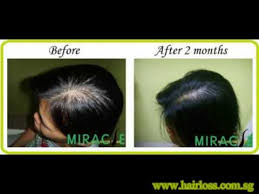 Subscribe to see month to month review Miracle Hair Regrowth Holistic Hair Loss Treatment Singapore Youtube
