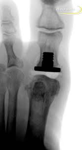 Search results for rochelle swanson. Hallux Rigidus Operative Therapie Mittels Hemiprothese Gelenk Klinik De