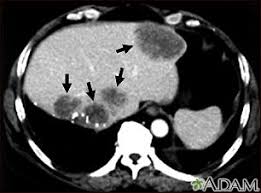 A ct scan of the upper abdomen showing multiple metastasis (cancer that has spread) in the liver of a patient with carcinoma of the large bowel. Abdominal Ct Scan Information Mount Sinai New York
