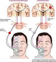 In bell's palsy, the affected nerve becomes inflamed due to injury or damage. Bell S Palsy Excluding Serious Illness In Urgent And Emergency Care Settings