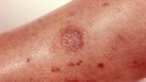 Image result for wolf spider bite skin