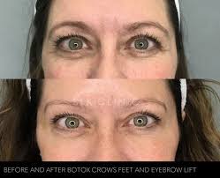 Advanced Eye Treatments for Youthful Results