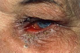 Image result for Conjunctivitis Resources