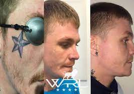 Laser tattoo removal in london our senior consultant jo explains the tattoo removal process, results and before and after of our. Laser Tattoo Removal Before And After In Plymouth Whiteroom Laser Ltd