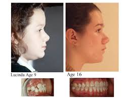 Hi everyone! I have this much crowding in my lower jaw. I want  braces/aligners treatment. I consulted two dentists, one told me that my  case requires extraction of two teeth marked as '