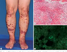 When there is a leakage of blood the capillaries become inflamed when the blood passes through the little gaps that occur between the cells that are making up the capillary wall. Figure 1 From Iga Vasculitis Complicated By Cytomegalovirus Enteritis A Case Report Semantic Scholar