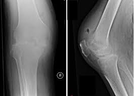 Image result for Septic Joint