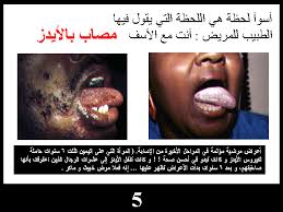الأربعاء 23 أبريل 2014 مقال عن الايدز مرض الايدز مع نهاية العقد الثامن عشر وبداية العقد التاسع عشر من القرن الماضي لا حظ الأطباء ظهور مرض وسط الشواذ جنسيا من الرجال اختير له اسم الايدز الذي بدأ بالانتشار بسرعه وسط فئات أخرى مهددا البشرية جمعاء فأصبح طاعونا