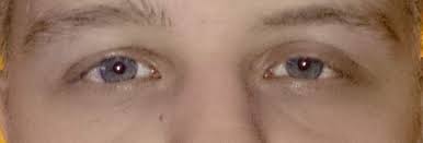 Augenlider Hangen Nach Botox