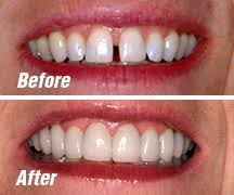 It is necessary to correct the gap, so to get a beautiful smile and appearance. Dentist Mona Vale Tooth Bonding For Tooth Chips Gaps And Stains Dentist Mona Vale