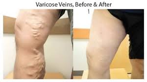 Insurance may pick up part of the tab, however, if the varicose veins are painful or debilitating. Varicose Vein Therapy And Varicose Vein Treatment In Cincinnati Cincinnati Oh Rejuveination