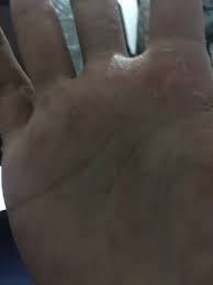 We did not find results for: Kulit Telapak Tangan Gatal Tanya Alodokter