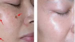 Namun anda juga bisa menggunakan cara menghilangkan bintik hitam di wajah secara alami dan mudah untuk dilakukan. Bintik Hitam Di Wajah Cara Hilangkan Bintik Hitam