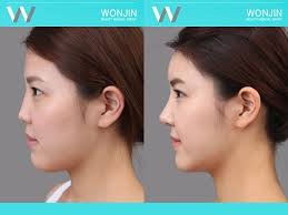 Fortunately there is a way to get these medical treatments done in english to take that risk away. Top 8 Plastic Surgery Procedures In Korea Quietly