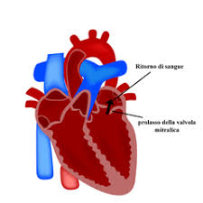 Il rigurgito mitralico acuto è un disordine in cui la valvola mitrale del cuore improvvisamente non si chiude correttamente, causando il refluire del sangue il rigurgito mitralico acuto può essere causato da una disfunzione o lesioni alla valvola a seguito di un attacco di cuore o di infezione della valvola di. Prolasso Della Mitrale Disturbi Accertamenti Terapia Issalute