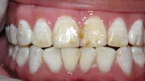 Dental Fluorosis My Teeth Are Affected By Severe Dental Practo Consult