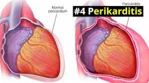 Sebagai wanita, apabila payudara sakit sebelah kanan pasti rasanya sangat tidak nyaman. Sakit Dada Sebelah Kiri Left Chest Pain Penyebab Cara Mengatasi