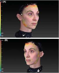 A Randomized Controlled Trial Evaluating Traditional Versus Extended  Techniques of Poly-L-Lactic Acid Injection for the Aestheti