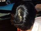 Early Crown Hair Loss